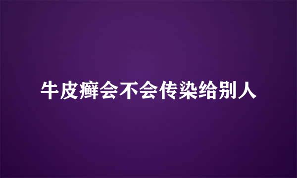 牛皮癣会不会传染给别人