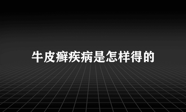 牛皮癣疾病是怎样得的